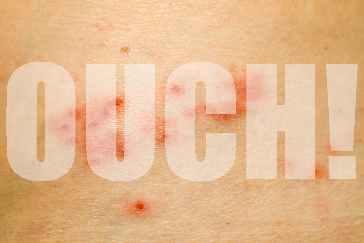 the word "ouch!" superimposed over a skin rash